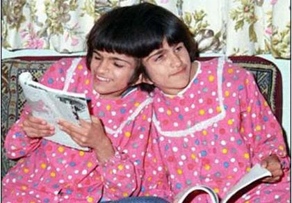 Những cặp song sinh dính liền vẫn sống tốt ảnh 2