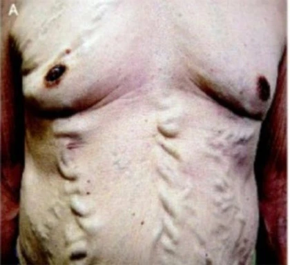 Bệnh lạ: Mạch máu nổi cuồn cuộn như rắn dưới da ảnh 1 Bệnh lạ: Mạch máu nổi cuồn cuộn như rắn dưới da ảnh 1