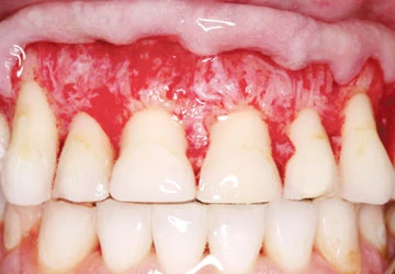 Răng trắng thì nướu... chẳng còn! ảnh 2