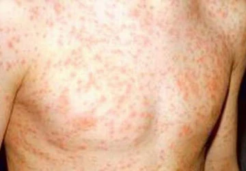 Chứng mề đay khi thời tiết chuyển mùa ảnh 1