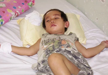 Mù, liệt sau khi mổ thoát vị bẹn ảnh 1