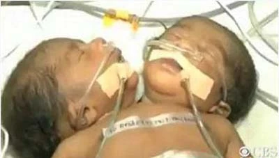 Những cặp song sinh dính liền vẫn sống tốt ảnh 1