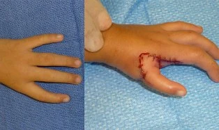 Chỉnh hình bàn tay không ngón cái ảnh 1