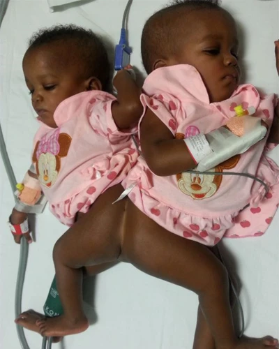 Tách thành công cặp song sinh dính liền xương sống ảnh 2