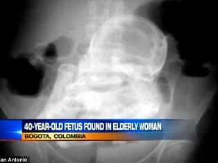 Thai hóa đá 40 năm trong bụng bà cụ ảnh 1