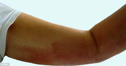 Nhiễm virus đậu mùa sau khi giải cứu mèo ảnh 1