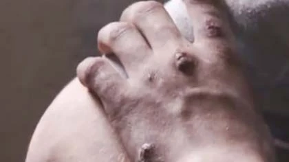 Xuất hiện loại “ma túy ăn thịt” tại Mỹ ảnh 1 Xuất hiện loại “ma túy ăn thịt” tại Mỹ ảnh 1