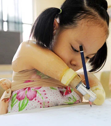 “Nick Vujicic Việt Nam” đã được lắp chân tay giả ảnh 1