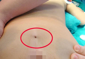 Trẻ bị liệt vì lỗ dò ảnh 1