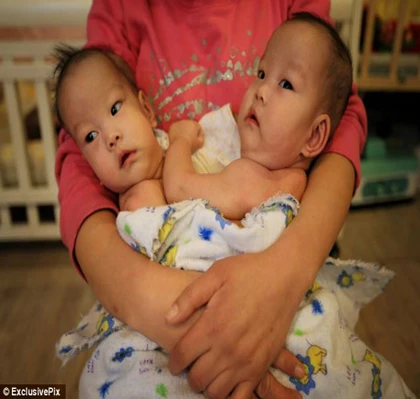 Trung Quốc: Cặp song sinh dính liền bụng bị bố mẹ bỏ rơi ảnh 1