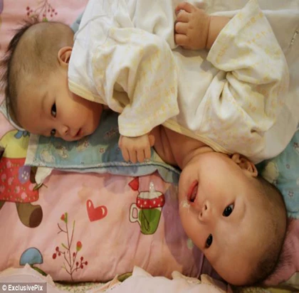 Trung Quốc: Cặp song sinh dính liền bụng bị bố mẹ bỏ rơi ảnh 2