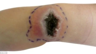 Nhiễm virus đậu mùa sau khi giải cứu mèo ảnh 1