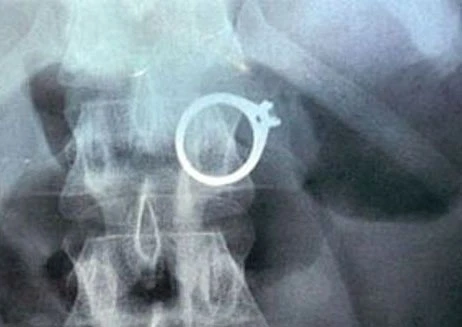 Nuốt vàng vào bụng để phi tang ảnh 1