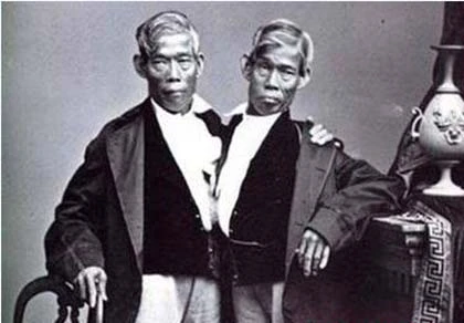 Những cặp song sinh dính liền vẫn sống tốt ảnh 4