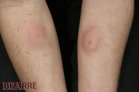 Người đàn ông “nghiện” tiêm nọc độc rắn vào người ảnh 3