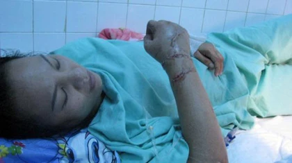 Sơ cứu khi bị đứt lìa tay, chân ảnh 1