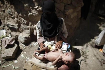 Những đứa trẻ teo tóp đáng thương ở Yemen ảnh 3