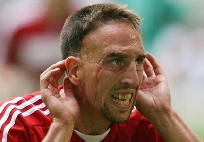 Ribery tự hào với mặt sẹo ảnh 1
