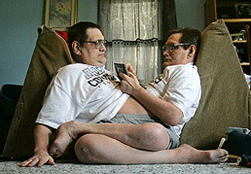 Cặp sinh đôi dính liền già nhất thế giới ảnh 1