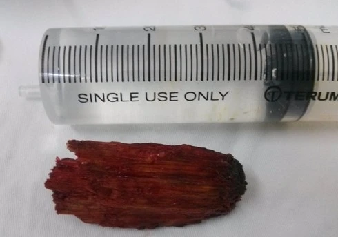 Ngã xe máy bị thanh gỗ xuyên thủng mắt ảnh 2