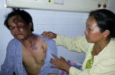 Hất xô axít vào chồng trong cơn cuồng ghen ảnh 2