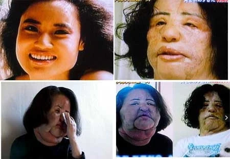 Hóa "Ngáo ộp" vì phẫu thuật thẩm mỹ ảnh 1