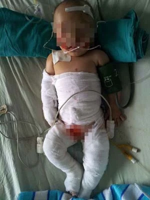 Sưởi than, bé 6 tháng tuổi bỏng nặng ảnh 1