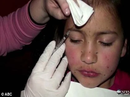 Sốc với bà mẹ tiêm botox vào mặt bé gái 8 tuổi ảnh 1
