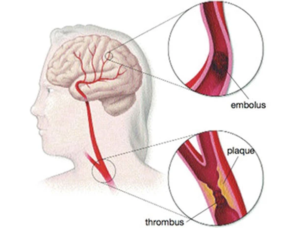 Nhũn não: nhân quả và bù trừ ảnh 2