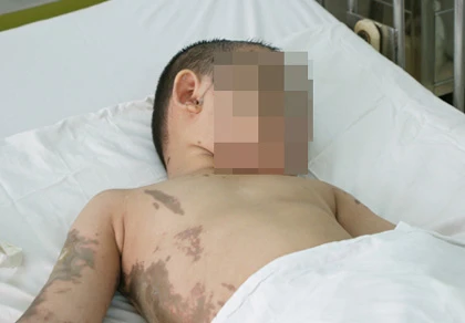 Cậu bé 5 tuổi bỏng nát gương mặt vì bị tạt axit ảnh 1