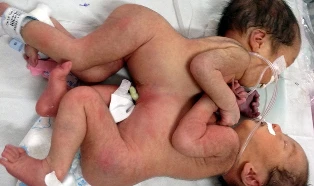 Hai bé gái dính nhau ngực, bụng ảnh 1