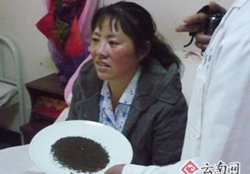 Phát hiện 11.688 viên sỏi trong túi mật bệnh nhân ảnh 1