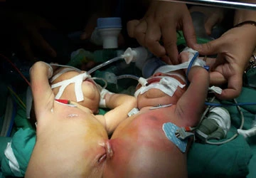 Chuyện hiếm: Song sinh dính nhau ra đời bằng sinh thường ảnh 1