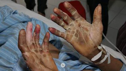 Một người tử vong do nhiễm liên cầu khuẩn lợn ảnh 1