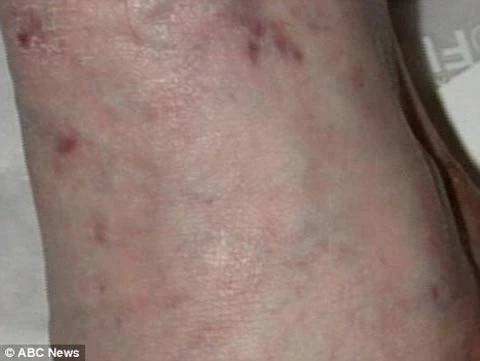 Những vết tiêm đã ngả màu trên chân siêu sao nhạc pop. Ảnh: ABC.