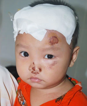 Lao vào xe lửa khu vui chơi, một trẻ nứt sọ ảnh 1