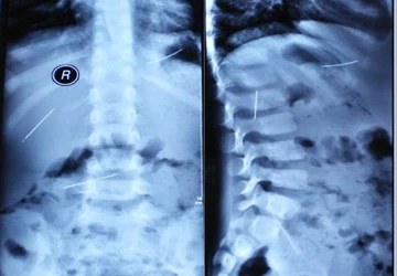 Cậu bé 5 tuổi có ba cây kim khâu trong ổ bụng ảnh 1