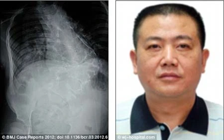 Kỳ lạ bé gái có tay “mọc” trên lưng ảnh 2