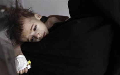 Những đứa trẻ teo tóp đáng thương ở Yemen ảnh 9