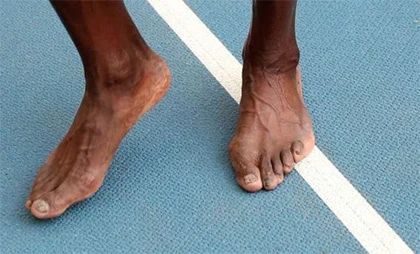 Chân của "tia chớp"Usain Bolt bị... biến dạng ảnh 1