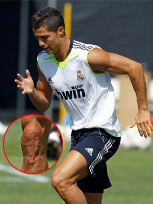 Cận cảnh đôi chân biến dạng của Cristiano Ronaldo ảnh 5