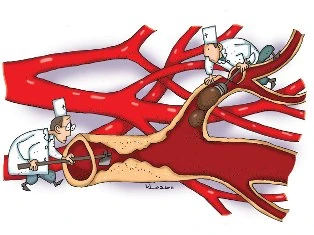 Nhũn não: nhân quả và bù trừ ảnh 1