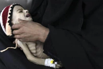 Những đứa trẻ teo tóp đáng thương ở Yemen ảnh 1