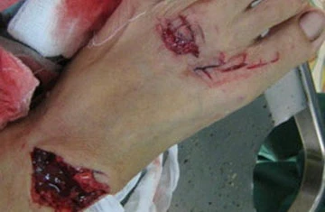 Cá dữ tấn công hai người tắm biển ở Quy Nhơn ảnh 1