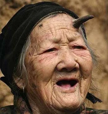 Cụ già có sừng trên trán sắp mọc thêm sừng mới ảnh 1