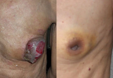 Ung thư vú nam: Diễn tiến rầm rộ ảnh 1