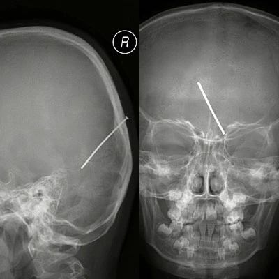 Bé 7 tuổi bị đinh dài gần 5cm đâm xuyên hộp sọ ảnh 1