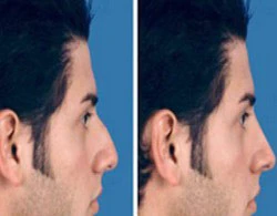 Thủng mũi vì làm đẹp ảnh 1