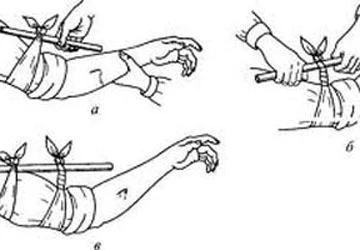 Tự garo - Thủ thuật y khoa dễ gây tai biến! ảnh 1