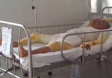 Đi xông hơi bị phỏng nặng ảnh 1